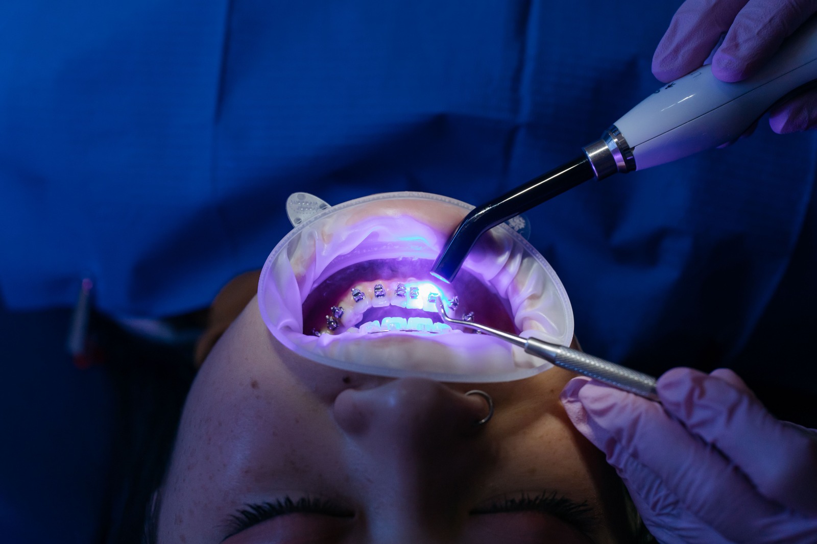 Close-up of bright white smile after professional whitening